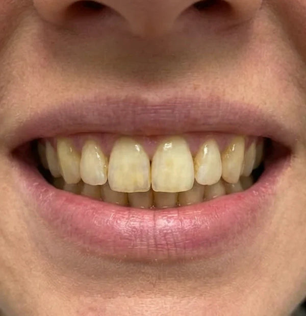 Purple Teeth Whitening Strips